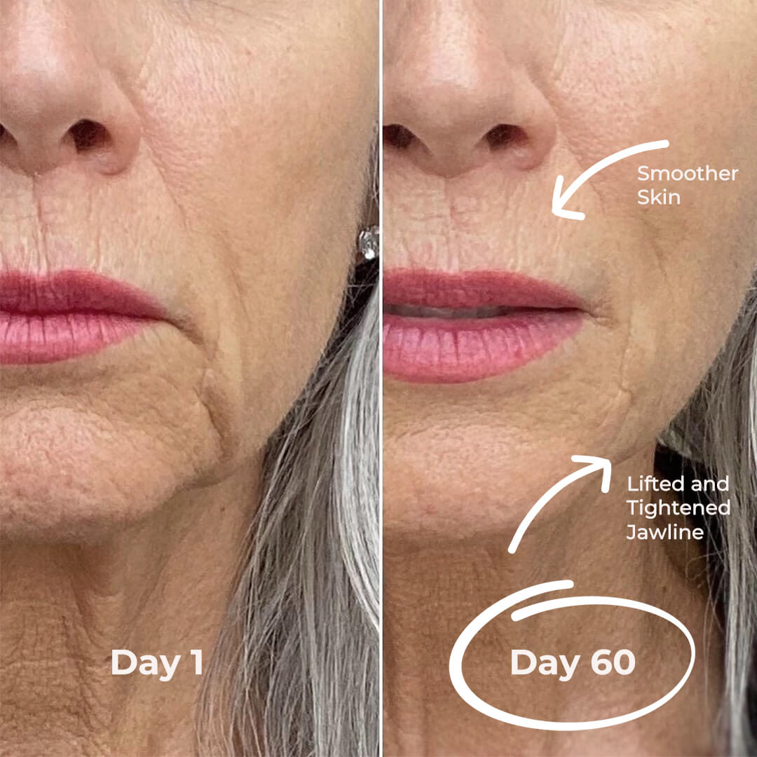 5MinSkin MikroSculpt + Hyaluronsäure Serum (30 Tage Vorrat)